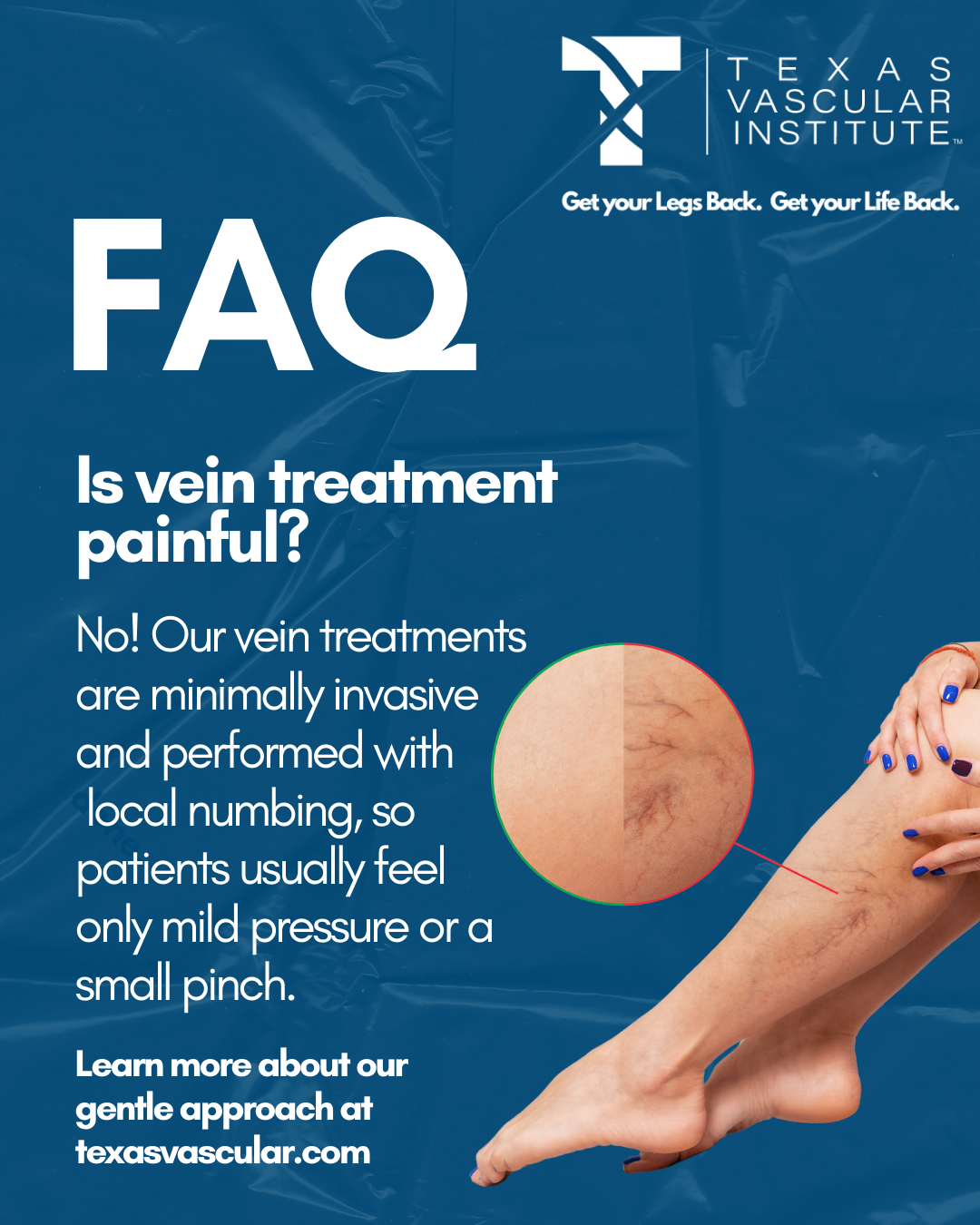TVI - FAQ Is Vein Treatment Painful